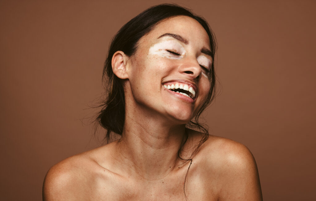Happy woman with skin condition