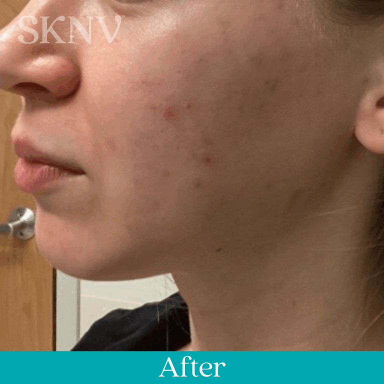Cheek with reduced acne bumps and clearer skin after using SKNV Azalta HP.