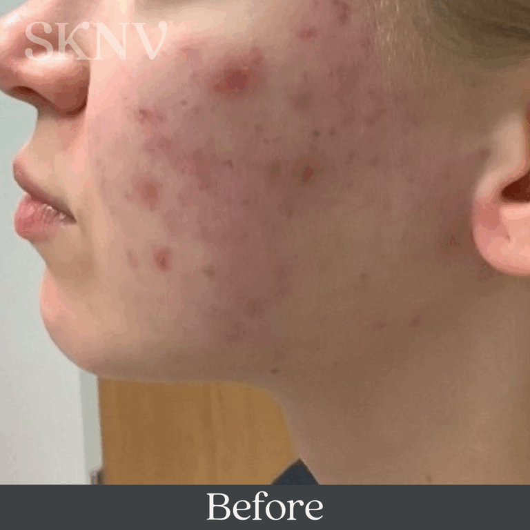 Cheek with visible acne bumps, redness, and inflammation before using SKNV Azalta HP.