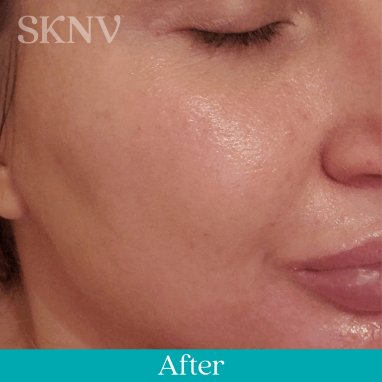 Results after using Rositara Gel