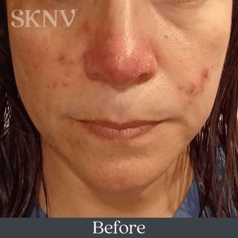 Cheek redness and visible rosacea irritation before starting SKNV Rositara Gel.