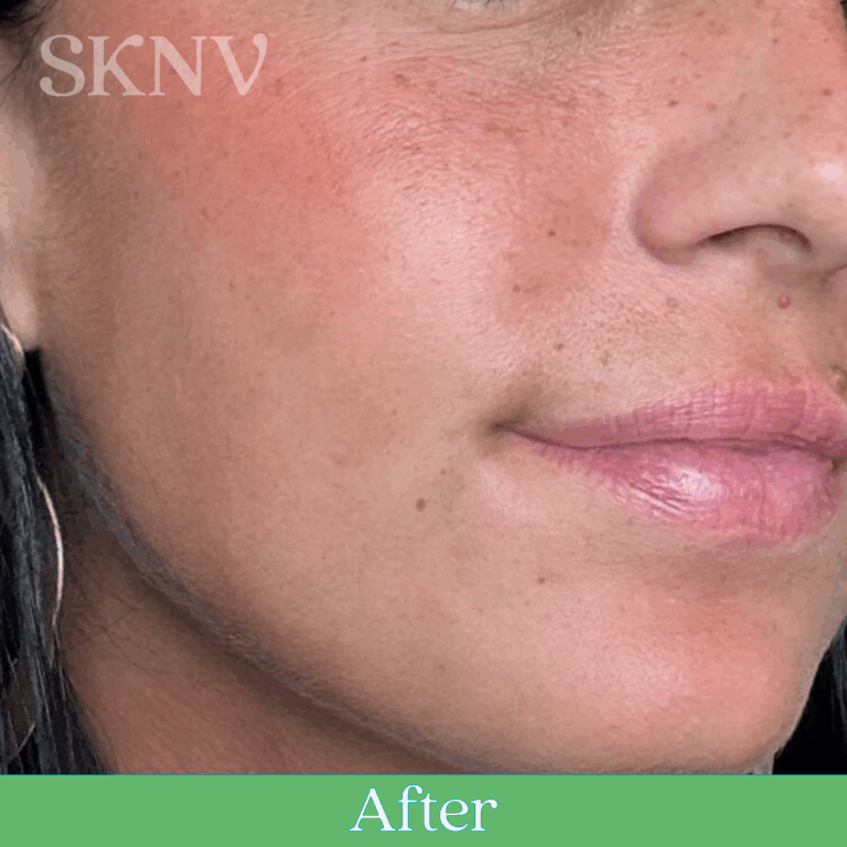 Cheek with smoother texture and reduced irritation after using SKNV’s eczema prescription.